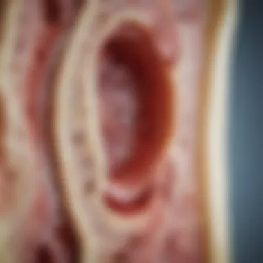 Bone Marrow Analysis in AML Microscopic view of bone marrow affected by Acute Myeloid Leukemia