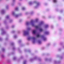 Histopathological slide illustrating anorectal squamous cell carcinoma