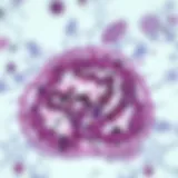 Histopathological slide showcasing malignant mixed Müllerian tumor characteristics