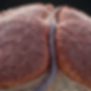 Implications of Accurate Staging on Prognosis in Multifocal Lung Adenocarcinoma Prognosis implications in multifocal lung adenocarcinoma